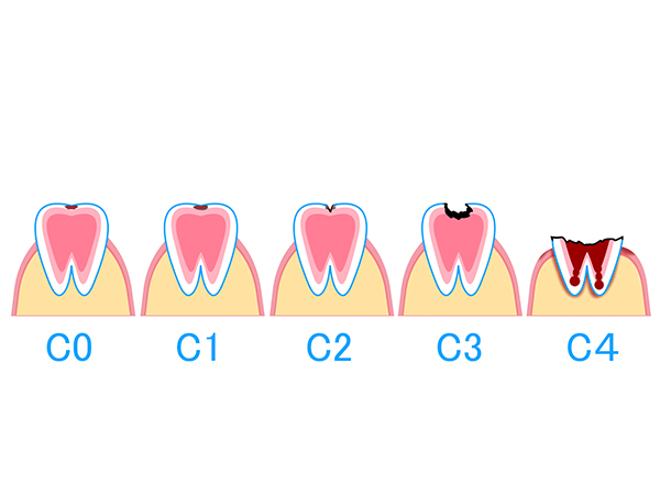 むし歯の進行過程